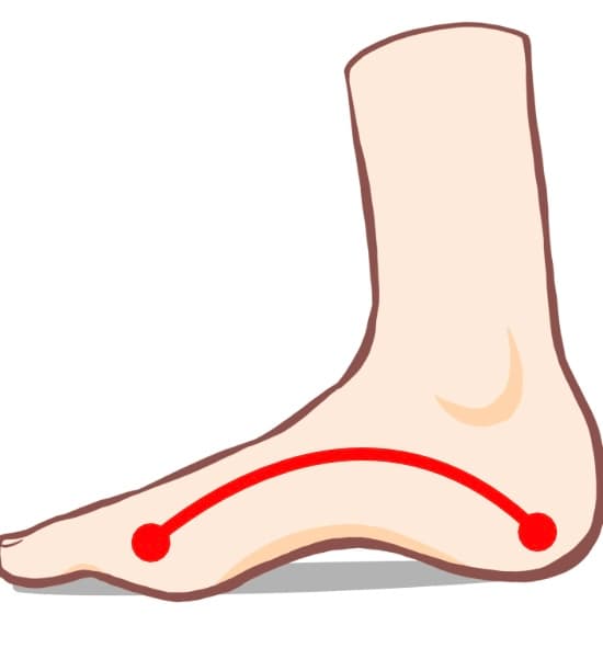 凹足(ハイアーチ)